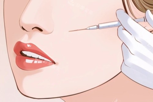 面部注射卡通一览 面部注射卡通一览