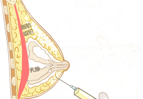 胸部奥美定注射物取出 胸部奥美定注射物取出