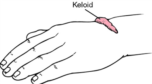 疤痕疙瘩3 疤痕疙瘩3