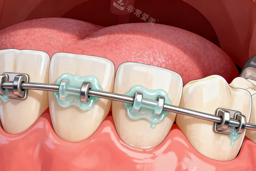 传统牙齿矫正方式一览