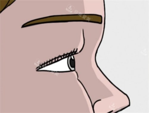 肿眼泡单眼皮示意图