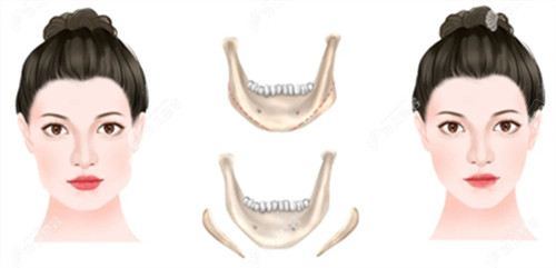 下頜骨截取手術(shù)前后對比圖
