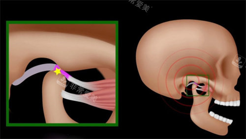 下颌骨错位部位