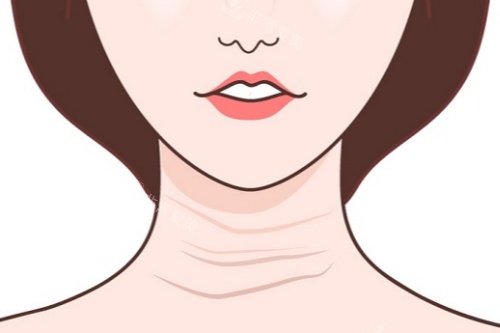 頸紋卡通圖片展示