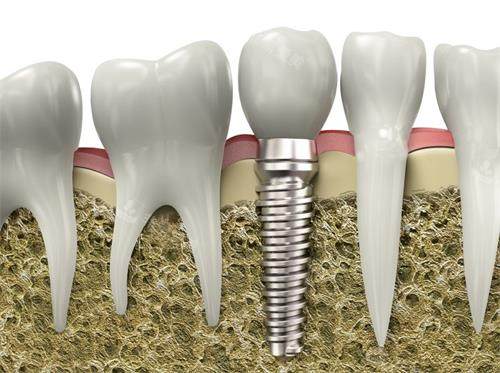 种植牙牙槽骨照片