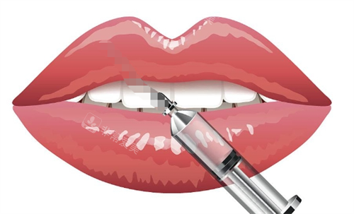 玻尿酸注射嘴巴动画展示