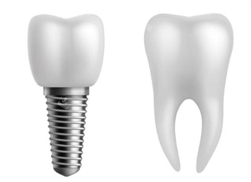 种植牙对比正常牙好在哪