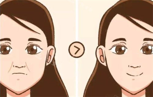 法令紋前后對(duì)比 法令紋前后對(duì)比