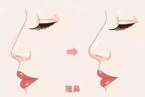 隆鼻对比示意图 隆鼻对比示意图