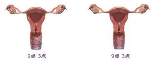 陰道緊縮手術(shù) 陰道緊縮手術(shù)