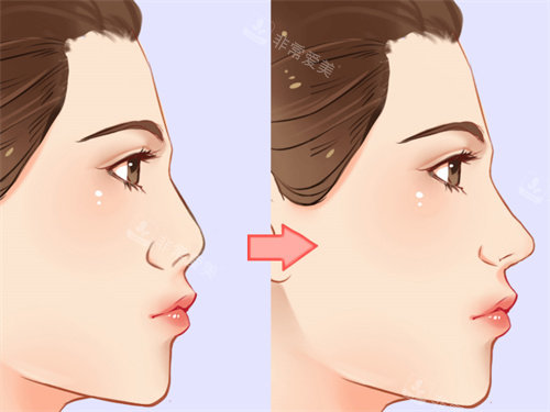 隆鼻手术前后对比展示 隆鼻手术前后对比展示