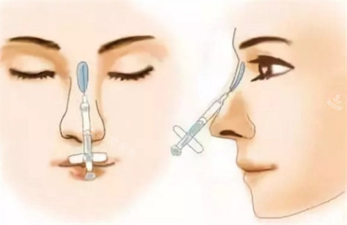 隆鼻材料注射 隆鼻材料注射