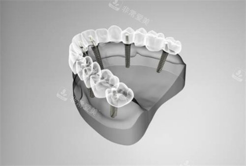 半口种植牙模拟示意图