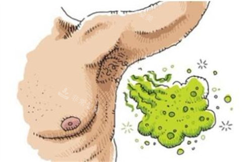 腋臭卡通图照片图 腋臭卡通图照片图