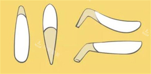 昆明艺星金辉医生做的鼻子怎么样？擅长处理宽鼻驼峰，术后鼻尖塑形立体！