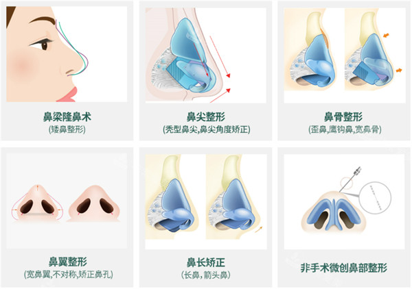 隆鼻手术方法 隆鼻手术方法