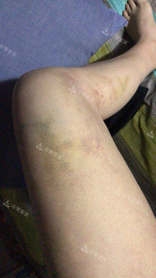 大腿吸脂术后淤青