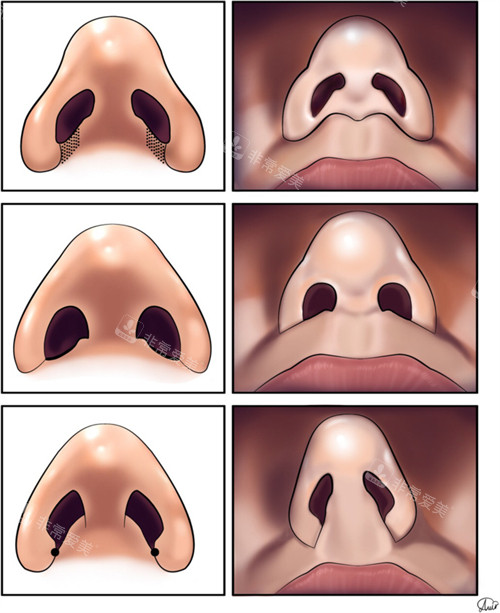 鼻整形的对比 鼻整形的对比