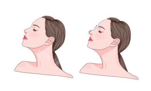 鼻整形术后示意图 鼻整形术后示意图