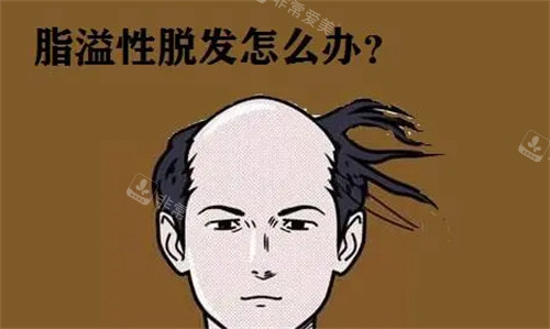 脂溢性脱发怎么办 脂溢性脱发怎么办
