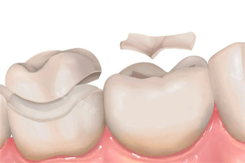 高位嵌体和一般嵌体对比