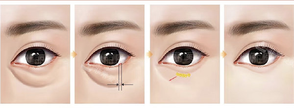 不开刀祛眼袋 不开刀祛眼袋