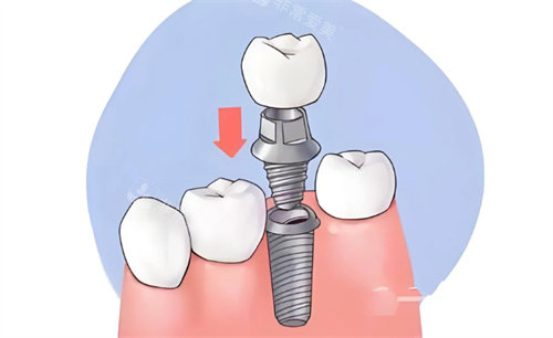 种植牙手术动画示意图