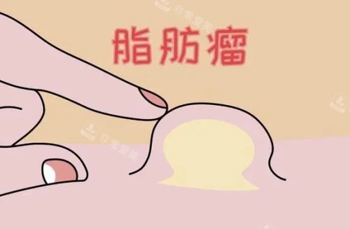 脂肪瘤漫画图