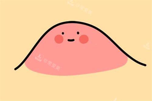 眼角脂肪粒示意图