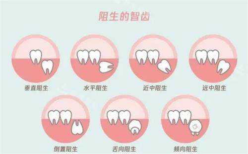 阻生智齿的示意图