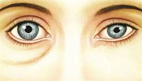 假性眼袋对比展示图