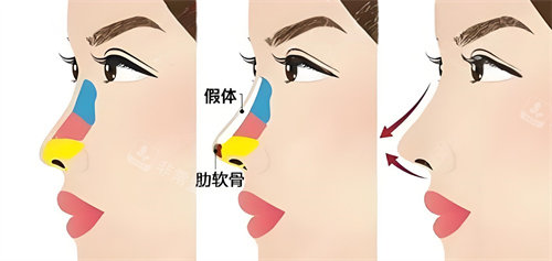 半肋骨隆鼻手術(shù)展示動畫圖 半肋骨隆鼻手術(shù)展示動畫圖