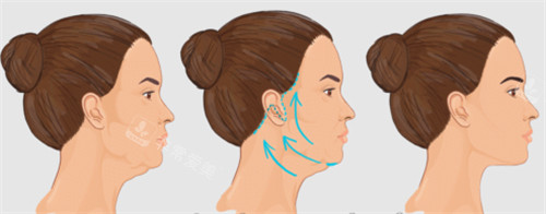 面部提升改善皮膚狀態(tài) 面部提升改善皮膚狀態(tài)