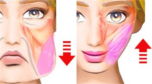 面部提升改善皮膚和脂肪下垂及位移 面部提升改善皮膚和脂肪下垂及位移