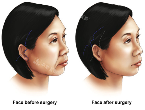 面部提升手術(shù)前后對(duì)比圖 面部提升手術(shù)前后對(duì)比圖