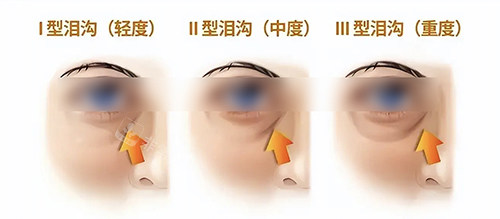 淚溝類型 淚溝類型