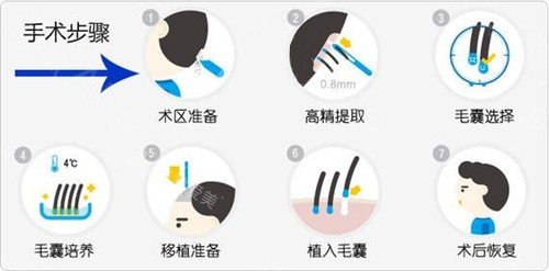 毛發(fā)移植手術(shù)步驟動(dòng)畫演示圖