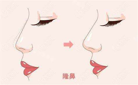 隆鼻术图