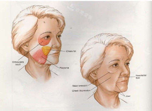 面部線提升對比