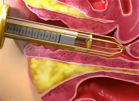 紧缩针过程示意图