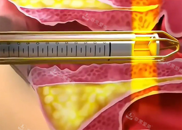 緊縮針推藥示意圖 緊縮針推藥示意圖