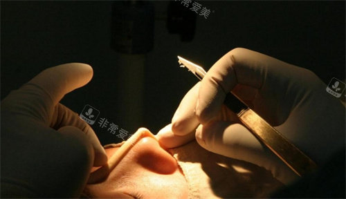 隆鼻整形细节图