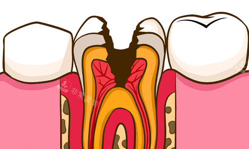 龋坏至牙髓展示