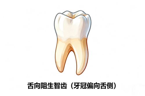 舌向阻生智齿展示图