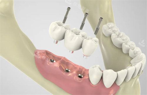 种植牙过程展示图片