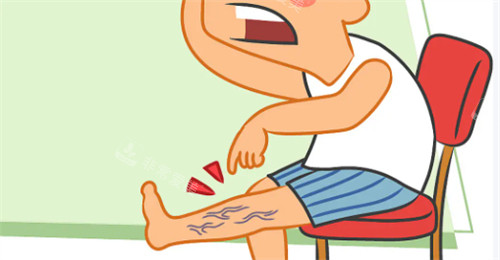 静脉曲张怎么办