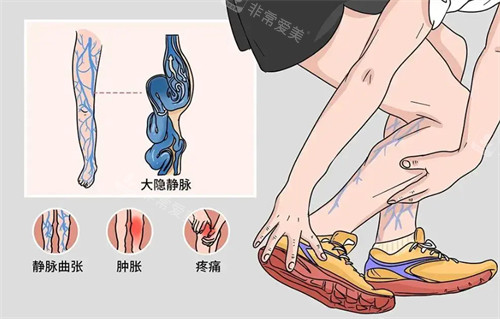 静脉曲张的危害