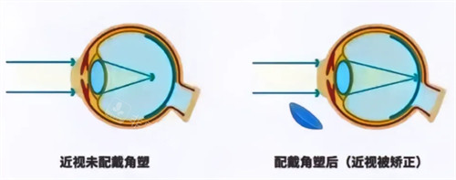 角膜塑形镜前后