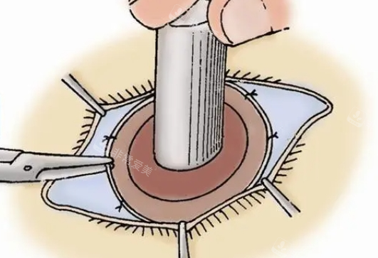 眼角膜移植手术操作展示