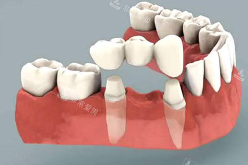 烤瓷牙冠展示图